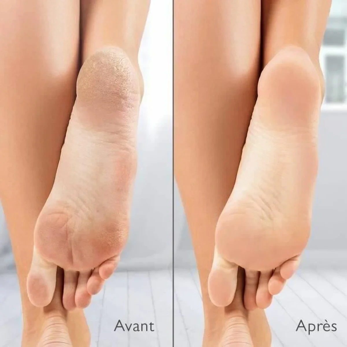 Removedor de Callos Eléctrico Silk´n Vacupedi (5 Unidades)