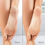 Removedor de Callos Eléctrico Silk´n Vacupedi (5 Unidades)